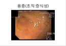대장암, 대장내시경, 대장암치료20130524 35페이지