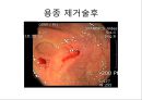 대장암, 대장내시경, 대장암치료20130524 36페이지
