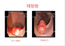 대장암, 대장내시경, 대장암치료20130524 38페이지