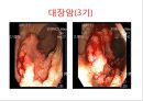 대장암, 대장내시경, 대장암치료20130524 39페이지