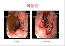 대장암, 대장내시경, 대장암치료20130524 40페이지