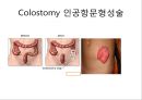 대장암, 대장내시경, 대장암치료20130524 52페이지