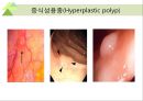 대장내시경에서 발견되는 소견 (대장 용종 및 대장암, 기타 소견).ppt 33페이지