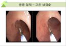 대장내시경에서 발견되는 소견 (대장 용종 및 대장암, 기타 소견).ppt 38페이지