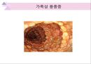 대장내시경에서 발견되는 소견 (대장 용종 및 대장암, 기타 소견).ppt 53페이지