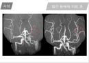 뇌혈관질환(뇌졸중) (Cerebrovascular disease).ppt 41페이지