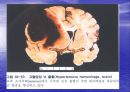 [뇌손상] 외상성 뇌손상[TBI]에 관해 9페이지