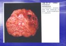 [뇌손상] 외상성 뇌손상[TBI]에 관해 10페이지