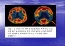 [뇌손상] 외상성 뇌손상[TBI]에 관해 25페이지