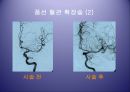 [의학] 뇌졸중 - 뇌졸중의 치료방법 18페이지