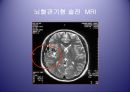 [의학] 뇌졸중 - 뇌졸중의 치료방법 25페이지