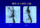 [의학] 뇌경색의 치료 8페이지