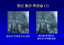 [의학] 뇌경색의 치료 10페이지