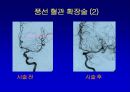 [의학] 뇌경색의 치료 11페이지
