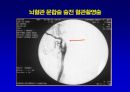 [의학] 뇌경색의 치료 14페이지