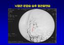 [의학] 뇌경색의 치료 16페이지