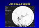[의학] 뇌경색의 치료 17페이지