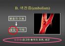 [의학] 뇌졸중 환자의 간호 10페이지