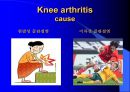 TKR(Total Knee Replacement)슬관절 대치술 PPT 6페이지