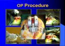 TKR(Total Knee Replacement)슬관절 대치술 PPT 19페이지