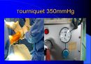 TKR(Total Knee Replacement)슬관절 대치술 PPT 23페이지