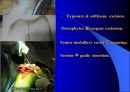 TKR(Total Knee Replacement)슬관절 대치술 PPT 26페이지
