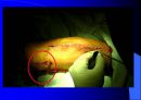 TKR(Total Knee Replacement)슬관절 대치술 PPT 31페이지
