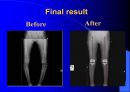 TKR(Total Knee Replacement)슬관절 대치술 PPT 33페이지