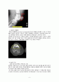 성인 골관절염간호과정 - 골관절염과 슬관절 케이스 스터디 (CASE STUDY ABOUT OSTEOARTHRITIS AND TOTAL KNEE REPLACEMENT) 6페이지