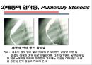 [의학] 선천성 심장질환[Congenital heart disease]에 관해 17페이지