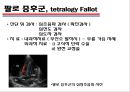 [의학] 선천성 심장질환[Congenital heart disease]에 관해 27페이지