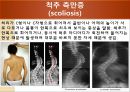 [물리치료] 척추에 대한 질환 5페이지