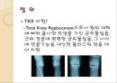 [의학] 인공 슬관절 전치환술 -TKR : Total knee replacement PPT자료 3페이지