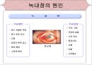 [의학간호학기초] 시각장애  - 녹내장 8페이지