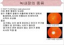 [의학간호학기초] 시각장애  - 녹내장 10페이지