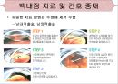[의학간호학기초] 시각장애  - 녹내장 19페이지