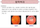 [의학간호학기초] 시각장애  - 녹내장 27페이지