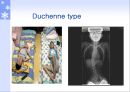 [질환별 물리치료] PMD[Progressive Muscular Dystrophy] 5페이지