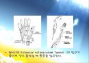 [질환별 물리치료] 드퀘르벵 디지즈[De Quervain\'s Tenosynovitis] 3페이지