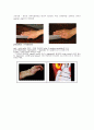 [의학] 기용 관 증후군[Guyon\'s canal syndrome]에 관해 3페이지
