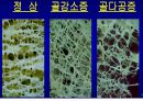 [의학] 골다공증[OSTEOPOROSIS]에 관해 6페이지