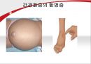[병리학] 당뇨병과 간경화증에 관해 26페이지