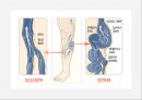 하지정맥류 varicose vein 원인 증상 및 예방  4페이지