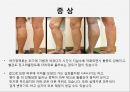 하지정맥류 varicose vein 원인 증상 및 예방  8페이지