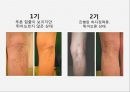 하지정맥류 varicose vein 원인 증상 및 예방  10페이지