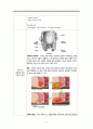 치루 절제술(Anal fistulectomy, Low type) 대상자 간호 보고서  2페이지