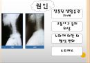 목 디스크(추간판 탈출증) 4페이지