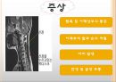 목 디스크(추간판 탈출증) 5페이지