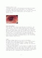 Crohn disease, 크론병 2페이지