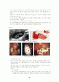 난소 종양 19페이지